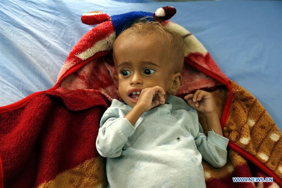 YEMEN-HODEIDAH-PATIENTS