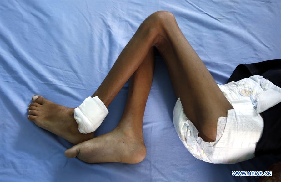 YEMEN-HODEIDAH-PATIENTS