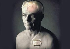 起搏器真的能治好帕金森病嗎？