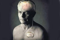 【健康解碼】起搏器真的能治好帕金森病嗎？